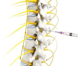 Epidural Injections