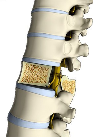 Osteoporosis