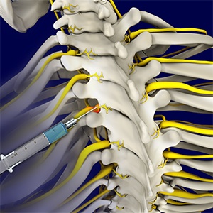 Selective Nerve Root Block